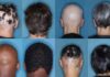 Hair Loss Treatment Options: Find the Right Solution for You Hair Loss Treatment Options