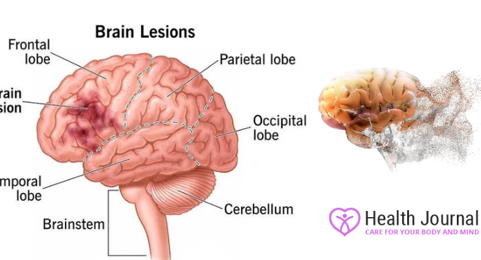 Brain Diseases: Types, Symptoms, and Early Detection Brain Disease