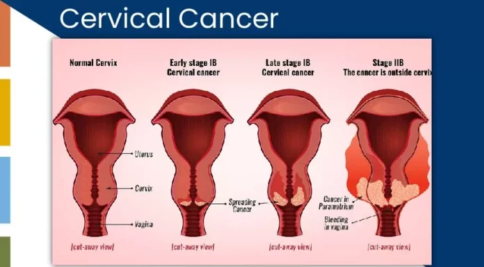 Everything You Need to Know About Cervical Cancer Cervical Cancer